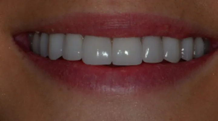 Dinți uniformi, fără spații, după fațete dentare, după tratament. Caz clinic The Good Clinic, Sector 2